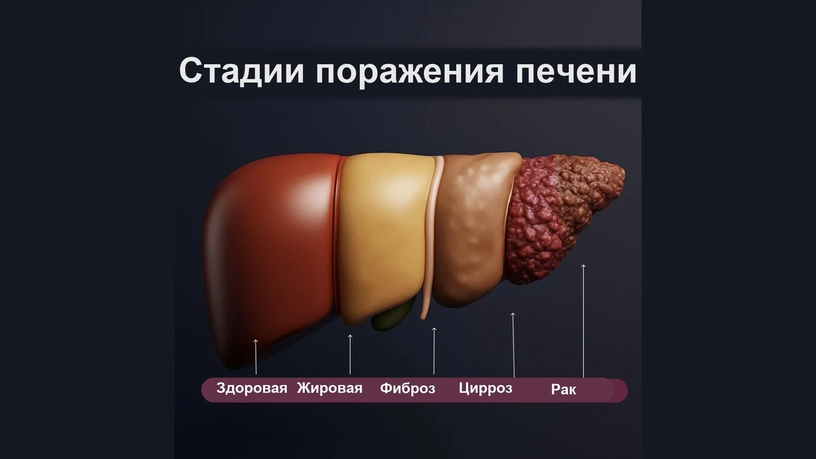 Стадии поражения печени — здоровая, жировая, фиброз, цирроз, рак